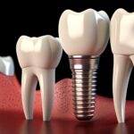 The Journey from Tooth Loss to Full Smiles with Dental Implants